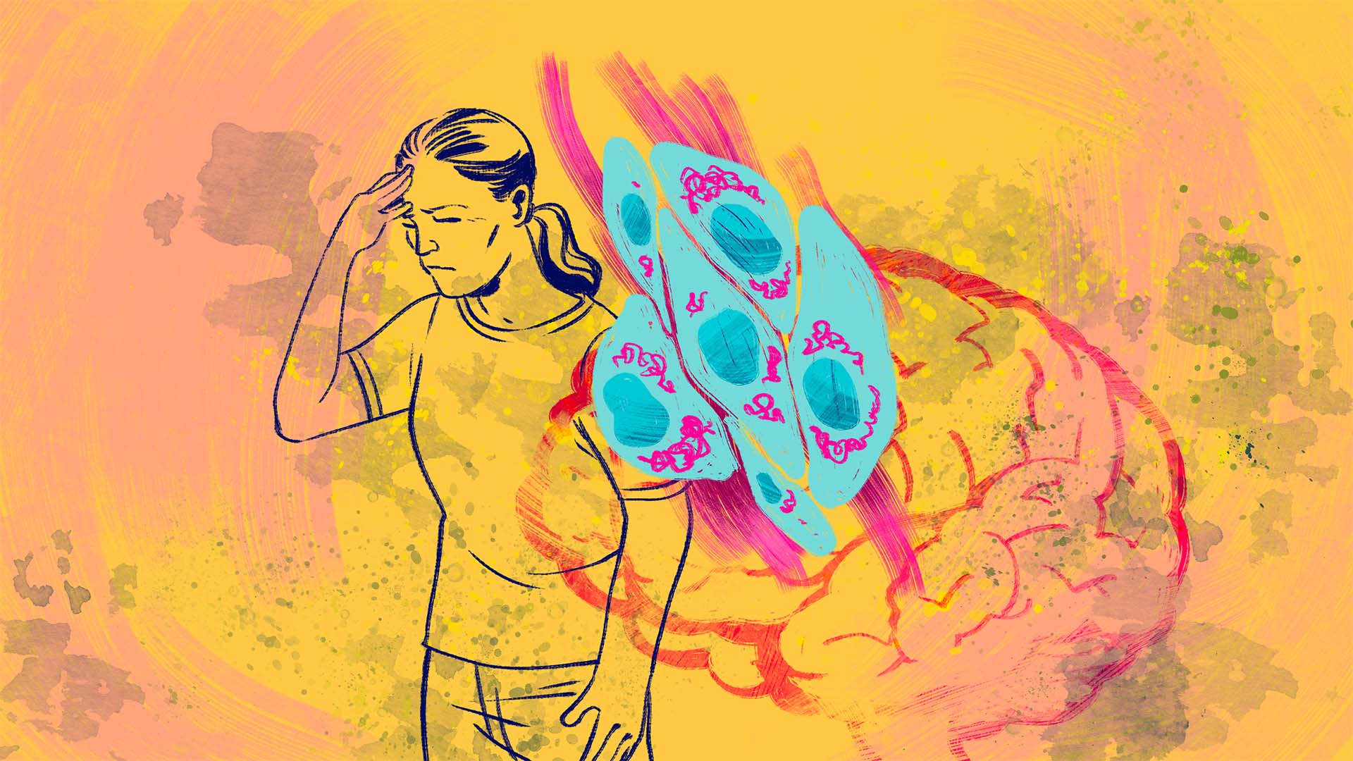  Illustration of a woman with a painful expression presses hand to head overlaid with an illustration of the brain